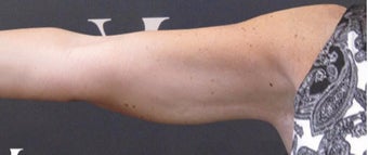 CoolSculpting performed on arms after 3265232