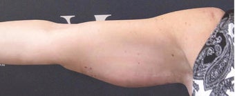 CoolSculpting performed on arms before 3265232