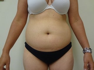 Tumescent Liposuction of abdomen before 1096053