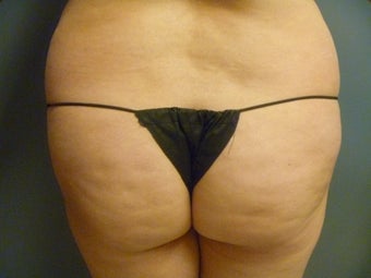 24 year old female presented for fat transfer to the buttocks before 1347272