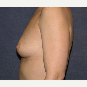 35-44 year old woman treated with Breast Implants before 3455618