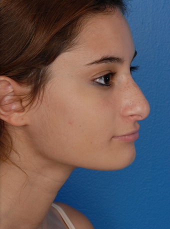 Rhinoplasty (Nose Surgery) before 1127253