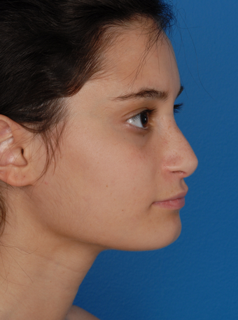 Rhinoplasty (Nose Surgery) after 1127253