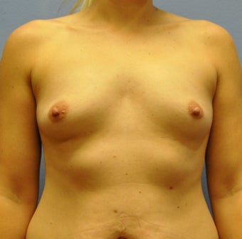Breast Augmentation, Breast Implants before 1535517