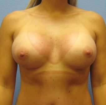 Breast Augmentation, Breast Implants after 1535517