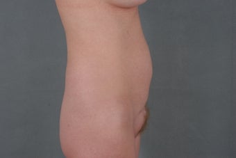 42 year old woman who was treated for a belly button hernia and loose skin to her abdomen after a c-section. 1114430