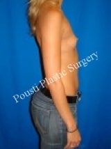 Breast Augmentation 687463