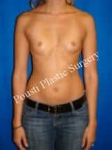 Breast Augmentation before 687463