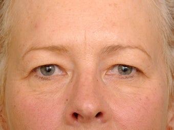 49 year old female before and one year after having a quality upper eyelid correction. before 1255236