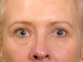 49 year old female before and one year after having a quality upper eyelid correction. after 1255236