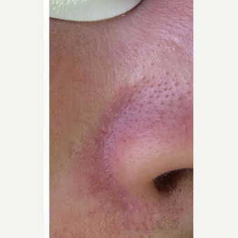 35-44 year old woman treated with IPL before 2995198