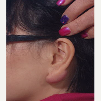 25-34 year old woman treated with Scar Removal before 3725559