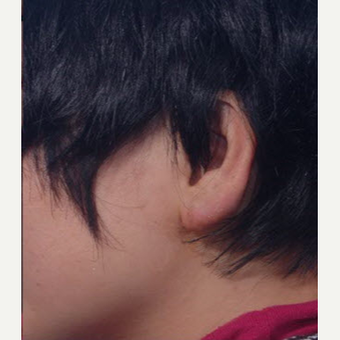 25-34 year old woman treated with Scar Removal after 3725559
