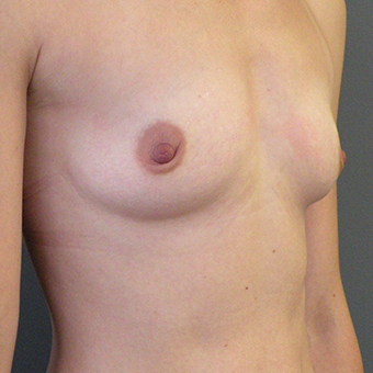 35-44 year old woman treated with Mentor Breast Implants before 3054643