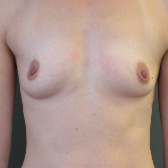 35-44 year old woman treated with Mentor Breast Implants 3054643
