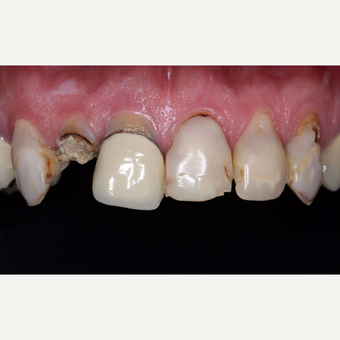 45-54 year old man treated with Dental Crown before 3629745