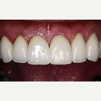 45-54 year old man treated with Dental Crown after 3629745