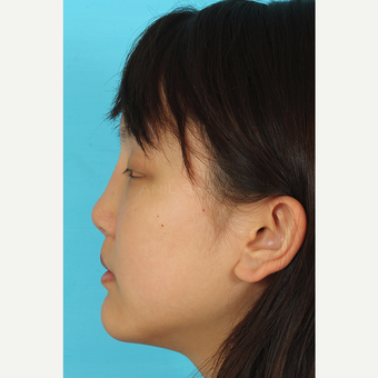 25-34 year old woman treated with Rhinoplasty after 3629078
