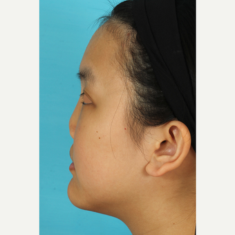 25-34 year old woman treated with Rhinoplasty before 3629078