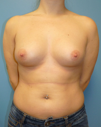 Breast Fat Transfer before 1579670