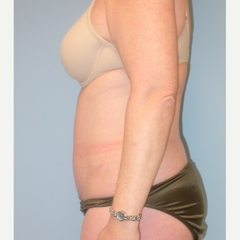 40 year old woman treated with Tummy Tuck after 3343737