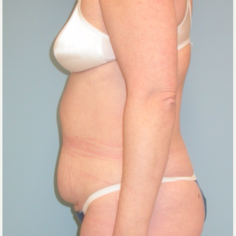 40 year old woman treated with Tummy Tuck before 3343737