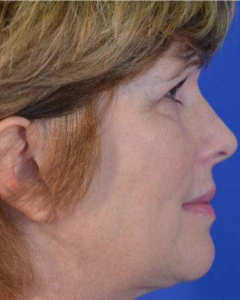 58 year old woman post Facelift, Upper Eyelid Blepharoplasty and Fat Transfer to the Cheeks after 3743081