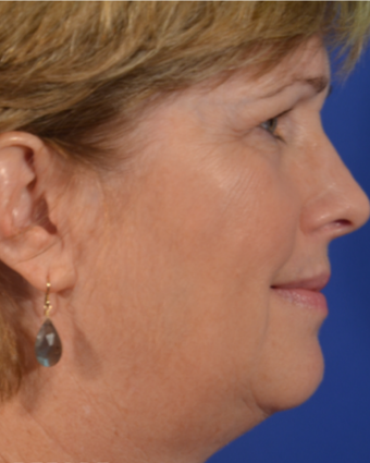 58 year old woman post Facelift, Upper Eyelid Blepharoplasty and Fat Transfer to the Cheeks before 3743081