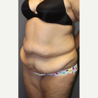 35-44 year old woman treated with Tummy Tuck before 3140824