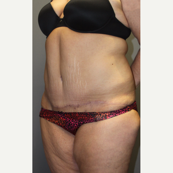 35-44 year old woman treated with Tummy Tuck after 3140824