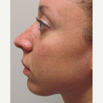 Elective Rhinoplasty for this 28 Year Old Woman before 3042964