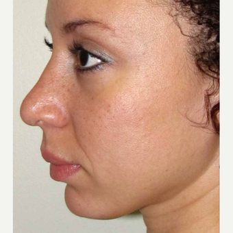 Elective Rhinoplasty for this 28 Year Old Woman after 3042964