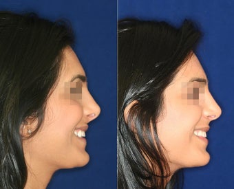 Nose Surgery before 1430783