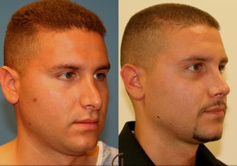 Revision Rhinoplasty after 251839
