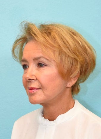65-74 year old woman treated with Facelift after 3476168