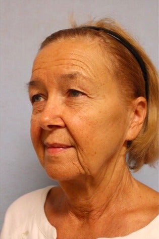 65-74 year old woman treated with Facelift before 3476168