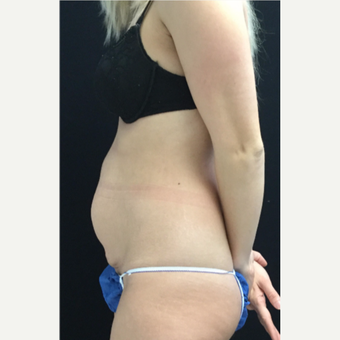 25-34 year old woman treated with Tummy Tuck before 3219074