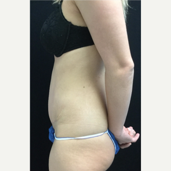 25-34 year old woman treated with Tummy Tuck after 3219074
