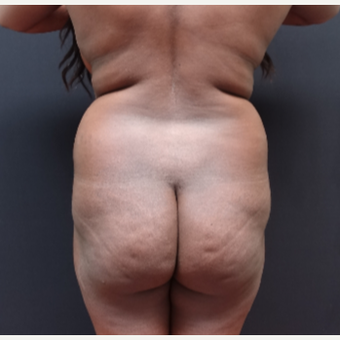 25-34 year old woman treated with Butt Augmentation before 3363826