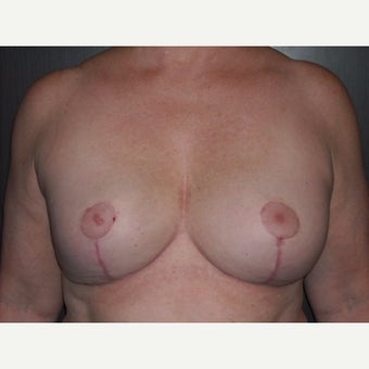 60 year old lady who wanted removal of her old breast implants followed by a breast lift. after 1737068