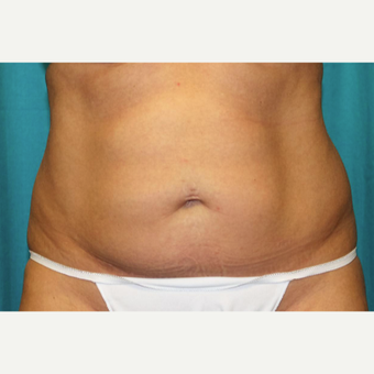 35-44 year old woman treated with CoolSculpting after 3398899