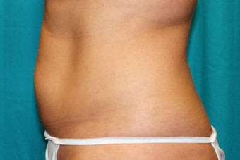 35-44 year old woman treated with CoolSculpting 3398899