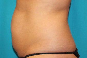 35-44 year old woman treated with CoolSculpting 3398899