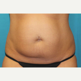 35-44 year old woman treated with CoolSculpting before 3398899