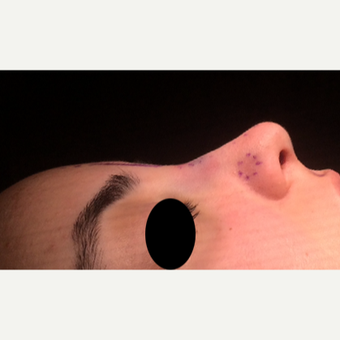 25-34 year old woman treated with Rhinoplasty after 3211228