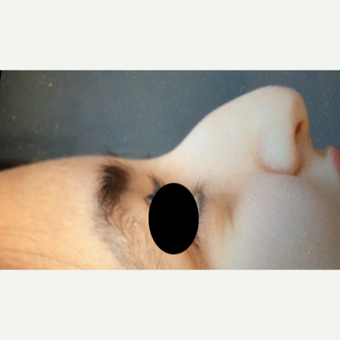 25-34 year old woman treated with Rhinoplasty before 3211228