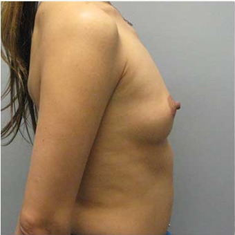 38 year old woman treated with Breast Augmentation before 3468276