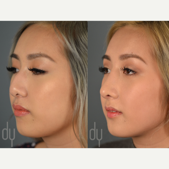 Asian Rhinoplasty with rib cartilage and DCF before 3129821