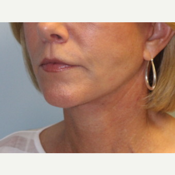 55-64 year old woman treated with Facelift after 3570828