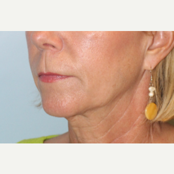 55-64 year old woman treated with Facelift before 3570828